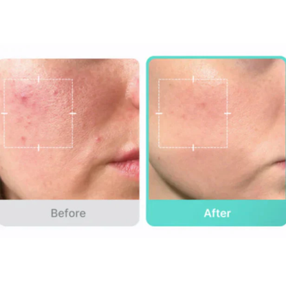 Azelaic Acid 16 BB Soothing Serum